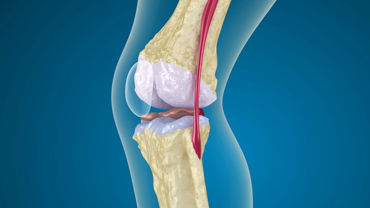 Destruction of the knee joint in osteoarthritis