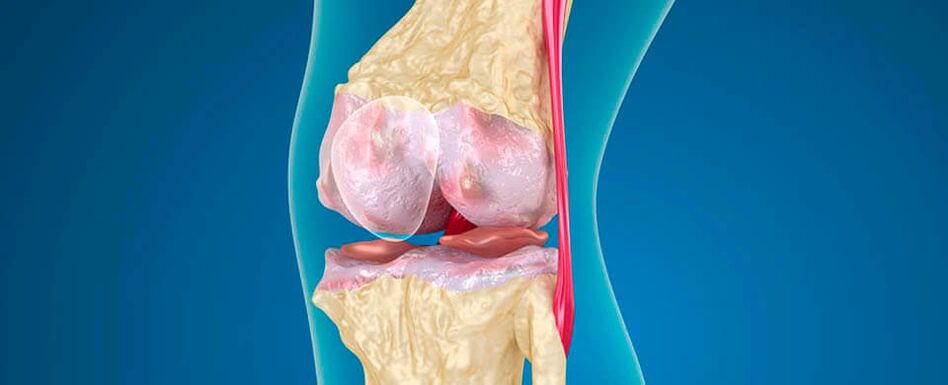 Osteoarthritis of the knee as the cause of pain