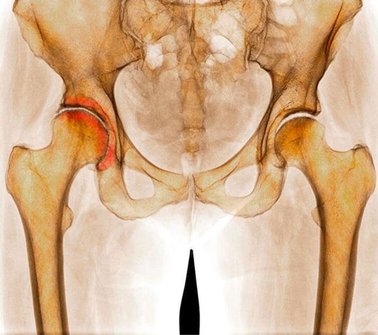 Inflammation of the hip joint as the cause of pain