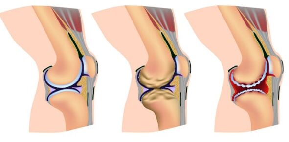Deformation stages of the knee joint