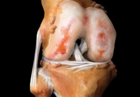 cyst