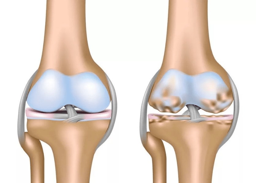 Arthrosis