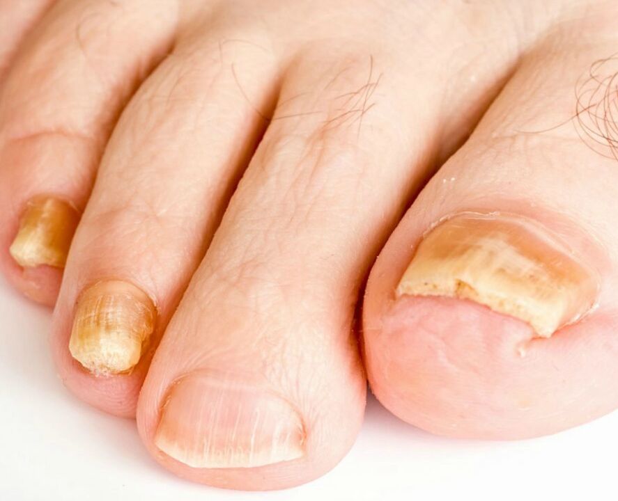 Mushroom on the nails