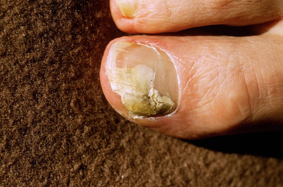 Onychomycosis