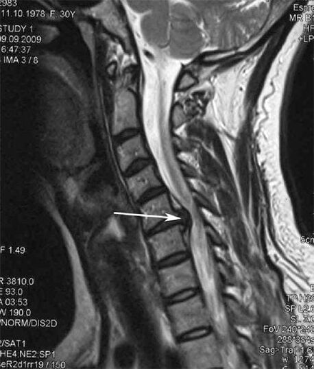 A spinal cord injury causes neck pain