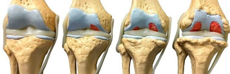 Stages of knee osteoarthritis