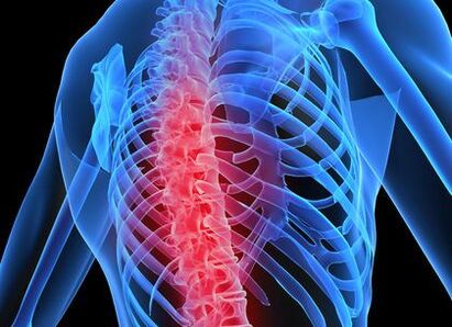 Osteochondrosis of the thoracic spine