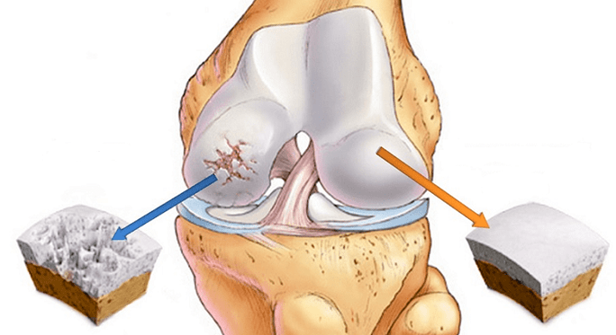 healthy cartilage affected by osteoarthritis