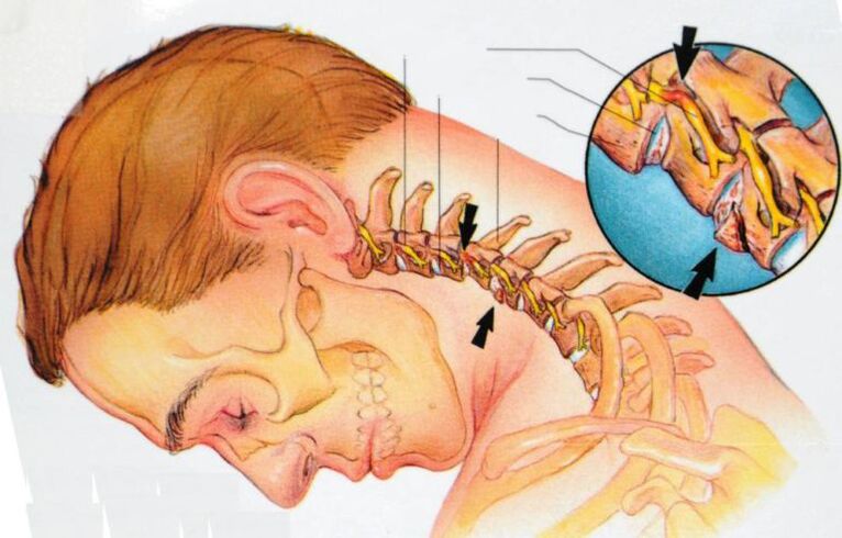 What happens with cervical osteochondrosis