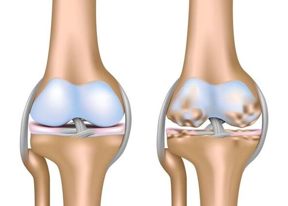 Osteoarthritis