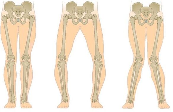 Types of osteoarthritis