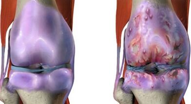 The main differences between arthritis and arthrosis