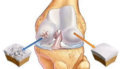 The reasons for the development of osteoarthritis of the joints