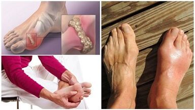 What is arthritis of the joints