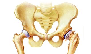 why osteoarthritis of the hip joint occurs